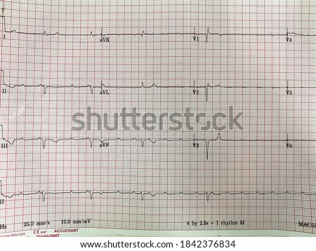 COMPLETE-HEART-BLOCK Stock Photos and Images - Avopix.com