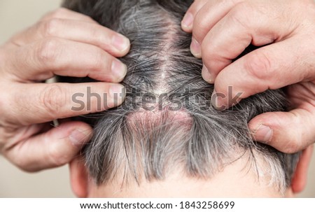 Head psoriasis. Head psoriasis. Psoriasis Vulgaris, psoriatic skin disease in hair, skin patches are typicaly red, itchy, and scaly, macro with narrow focus. Royalty-Free Stock Photo #1843258699