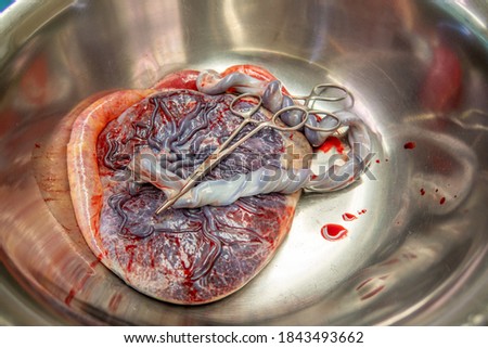 a placenta with umbilical cord is in a silver saline bowl after a birth Royalty-Free Stock Photo #1843493662