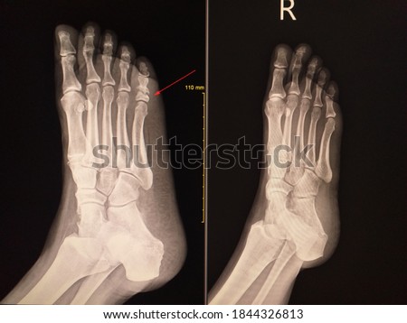 X-ray foot 2 views Showing Normal and fracture proximal phalanges 5th Royalty-Free Stock Photo #1844326813