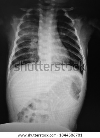 Film X-ray whole body of child