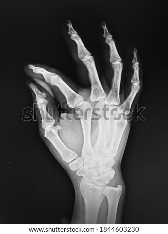 X-ray adult's hand bone anatomy