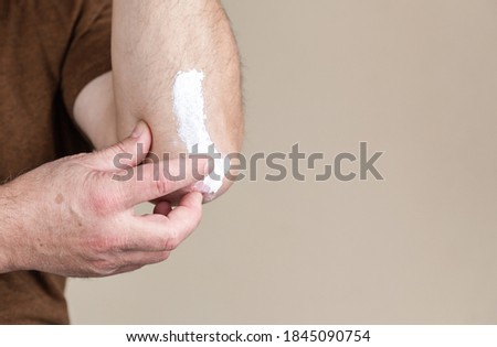 psoriasis ointment. treatment of skin diseases using ointments as dosage form of drug. Patient causes medical therapeutic ointment thick consistency or cream moisturizer on skin in elbow area close-up Royalty-Free Stock Photo #1845090754