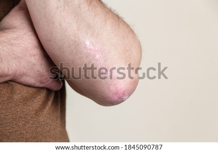 Psoriasis on the elbow. Closeup dermatitis on skin ill allergic rash dermatitis eczema of patient atopic dermatitis symptom skin detail texture, Fungus concept dermatology, treatment fungal and fungal