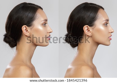 chin lift. photo before after Royalty-Free Stock Photo #1845421396