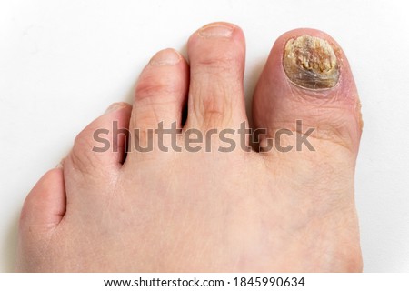 Sick nail on the foot. Toenail fungus on white background. Sore toenail, nail fungus close up. Royalty-Free Stock Photo #1845990634