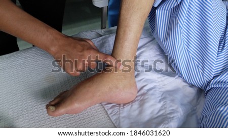 Swollen leg with pedal Oedema demonstrated by pressing against the medial aspect of lower limb.  Royalty-Free Stock Photo #1846031620