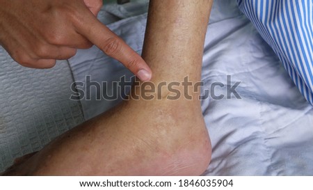 Swollen leg with pedal Oedema demonstrated by pressing against the medial aspect of lower limb.  Royalty-Free Stock Photo #1846035904