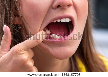 Young woman without tooth on lower jaw. Missing tooth. Waiting an implant after tooth extraction Royalty-Free Stock Photo #1848157708