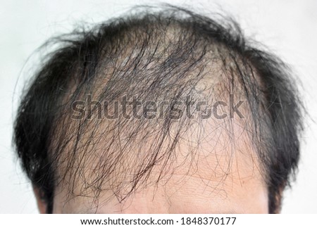 Thinning or sparse hair, male pattern hair loss in Southeast Asian, Chinese elder man.  Forehead of old man. Isolated on white. Royalty-Free Stock Photo #1848370177