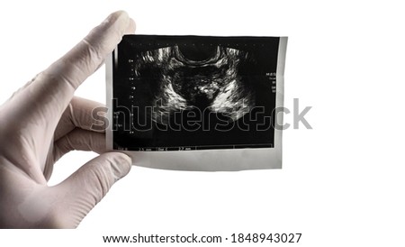 Prostate ultrasound scan on isolated white background, picture of the prostate at the doctor's hand. Prostata place for text for labeling and inserting details.