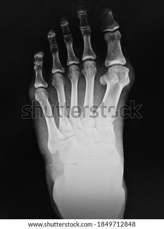 film X-ray show  bone of human's foot