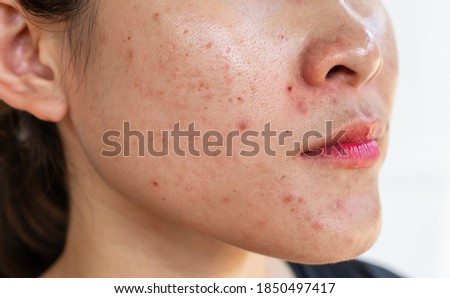 Cropped shot of woman having problems of acne inflamed on her face. Inflamed acne consists of swelling, redness, and pores that are deeply clogged with bacteria, oil, and dead skin cells. Royalty-Free Stock Photo #1850497417