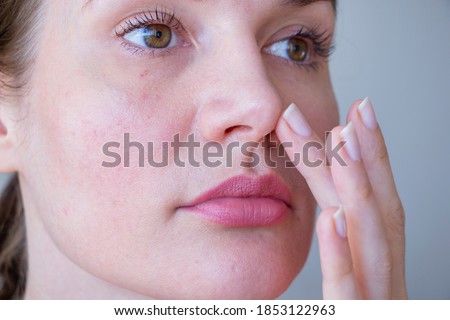 
Young woman with rosacea problem on face Royalty-Free Stock Photo #1853122963