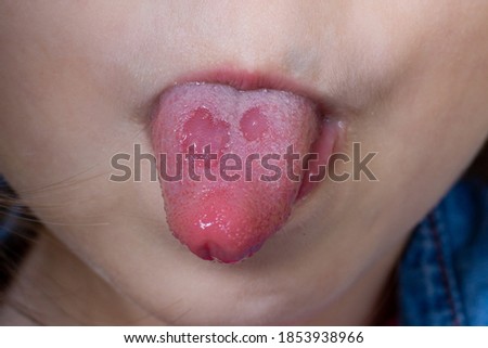 Kid have aphthous ulcers on mouth. Amphotoid stomatitis. Candidiasis of the tongue. Ulcer on the tongue.  Royalty-Free Stock Photo #1853938966