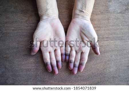 Cyanotic hands or peripheral cyanosis or blue hands at Southeast Asian, Chinese old woman with congenital heart disease. Royalty-Free Stock Photo #1854071839