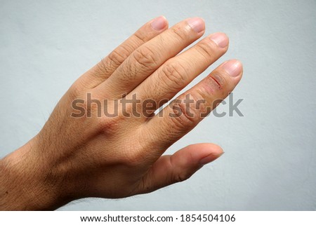 Skin is matt and cracked, the index finger is wound. Finger dermatitis, Skin disease.