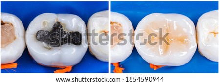 Amalgam (Mercury) filling replacing with ligt cure composite after root canal treatment Royalty-Free Stock Photo #1854590944
