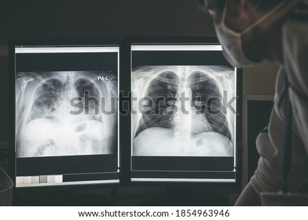 Doctor radiologist looking at difference between healthy and damaged lungs on x-ray image of patient with coronavirus Covid-19. Royalty-Free Stock Photo #1854963946