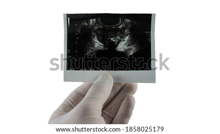 Picture of prostatitis, the picture of the prostate is isolated on a white background. Place for the text.