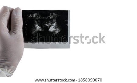 Shot of male prostate on white isolated background, place for text. Prostatitis male
