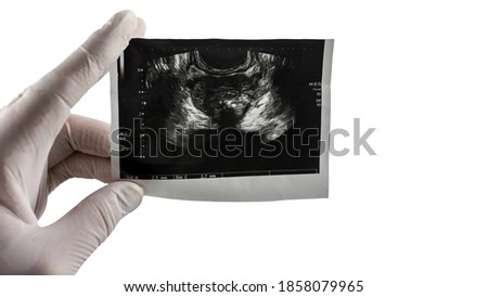 The male prostate in the picture is isolated on a white background. Picture of prostatitis. Place for text.