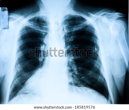 X-Ray Image Of Human Chest & Lung for a medical diagnosis 