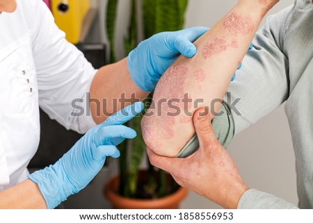 A dermatologist wearing gloves examines the skin of a sick patient. Examination and diagnosis of skin diseases-allergies, psoriasis, eczema, dermatitis. Royalty-Free Stock Photo #1858556953