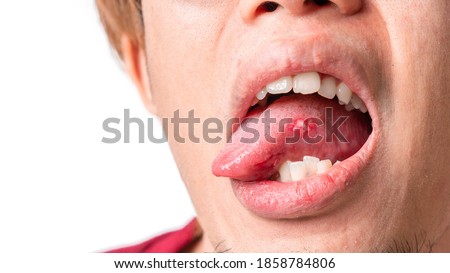 Asian man have aphthous ulcers on tongue on white background, selective focus. Royalty-Free Stock Photo #1858784806
