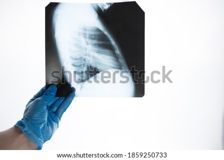 X-ray close-up side view of ribs and lungs in the hands of a doctor in blue gloves. The doctor examines the picture for pneumonia.