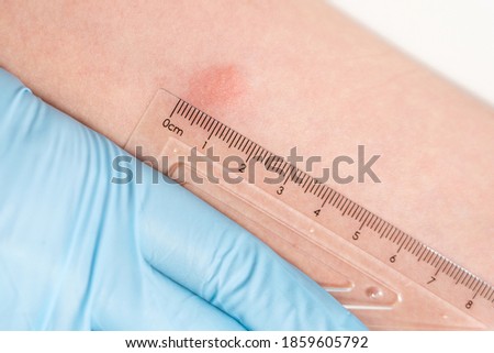 Closeup view photography of child's hand with red spot reaction to conducting Mantoux test after 72 hours from injection. Nurse in blue gloves applying transparent ruler to check reaction.