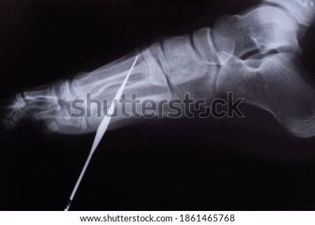 foreign body foot x-ray of a child Royalty-Free Stock Photo #1861465768