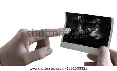 A medical professional is holding a snapshot of the prostate. Prostatitis isolated on white background