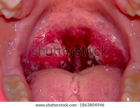 Severe Streptococcal Pharyngitis shown in a white adult male. Royalty-Free Stock Photo #1863804946