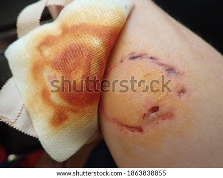 detail of a dog bite wound on a hand with iodine desinfection Royalty-Free Stock Photo #1863838855