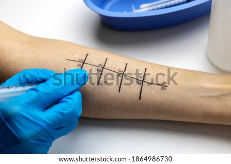 immunologist doing skin prick allergy test on a patient arm Royalty-Free Stock Photo #1864986730
