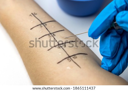 allergist doing skin prick allergy test on a patient arm closeup Royalty-Free Stock Photo #1865111437
