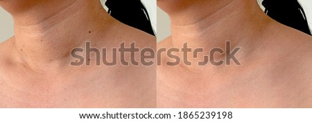 Imperfect Skin texture retouched, skin tags removal before and after treatment concept