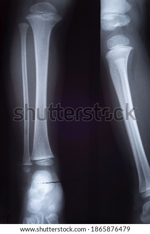 fracture of the shin bones x ray of the child
