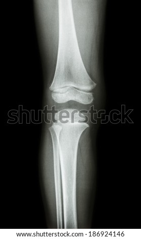 film x-ray knee AP(antero-posterior) of child