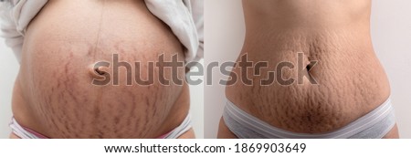 pregnant belly and belly with stretch marks after pregnancy Royalty-Free Stock Photo #1869903649