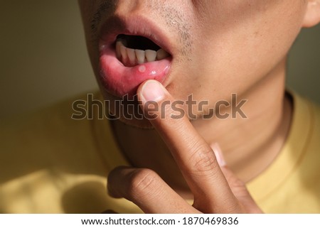 close up man's lip have a mouth ulcer. Stomatitis on the lip. Health problem concept. Royalty-Free Stock Photo #1870469836