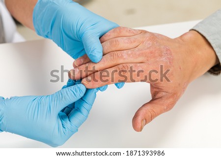 A dermatologist wearing gloves examines the skin of a sick patient. Examination and diagnosis of skin diseases-allergies, psoriasis, eczema, dermatitis. Royalty-Free Stock Photo #1871393986