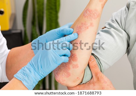 A dermatologist wearing gloves examines the skin of a sick patient. Examination and diagnosis of skin diseases-allergies, psoriasis, eczema, dermatitis. Royalty-Free Stock Photo #1871688793