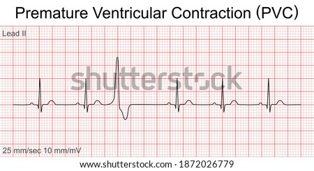 Electrocardiogram show Premature Ventricular Contraction (PVC) pattern ,Heart beat ,ECG ,EKG interpretation ,Vital sign ,Life line ,Medical healthcare symbol. Royalty-Free Stock Photo #1872026779