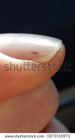 Subungual Splinter Hemorrhage due to subacute bacterial endocarditis Royalty-Free Stock Photo #1873510972