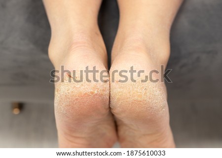 Corn callus cracks on sole heel foot close up. Dry skin dermatology problem. bloody cracks, common skin disease in dry winter, dehydrated skin on the heels of male feet with calluses Royalty-Free Stock Photo #1875610033