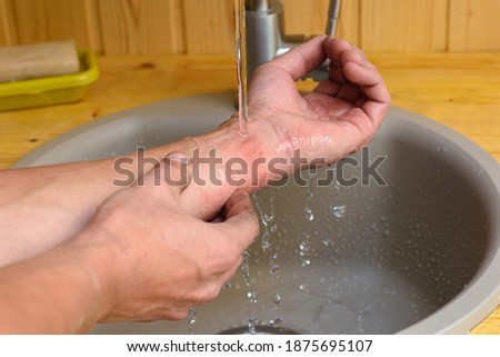 A man washes the wound on his arm under running water in the sink Royalty-Free Stock Photo #1875695107
