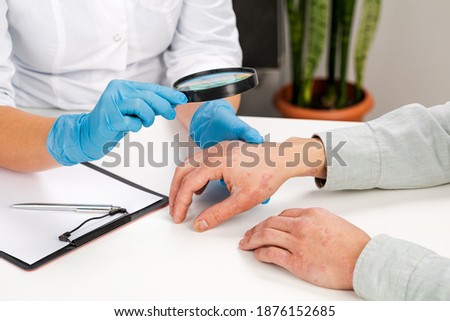 A dermatologist wearing gloves examines the skin of a sick patient. Examination and diagnosis of skin diseases-allergies, psoriasis, eczema, dermatitis. Royalty-Free Stock Photo #1876152685