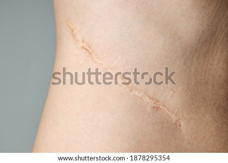 surgery scar after kidney pyelonephritis.  Royalty-Free Stock Photo #1878295354